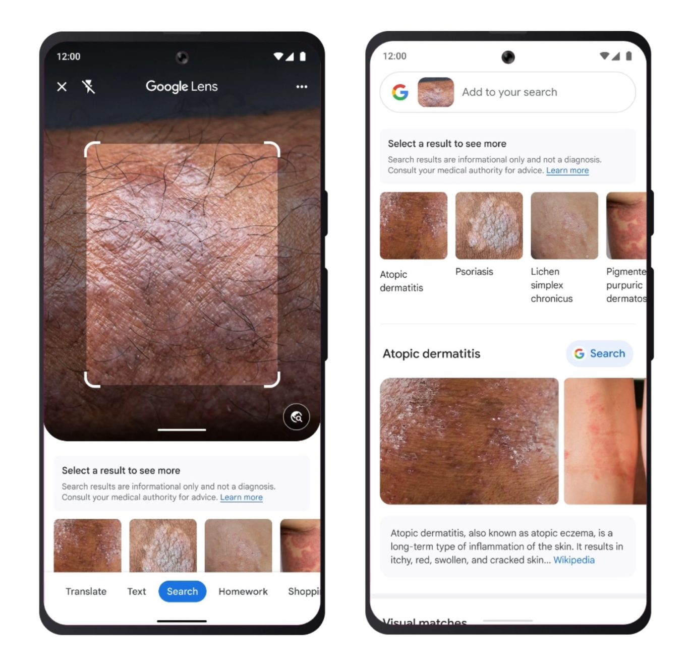 google-lens-can-identify-skin-conditions-and-is-coming-soon-to-bard